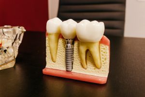 Maquette implant dentaire