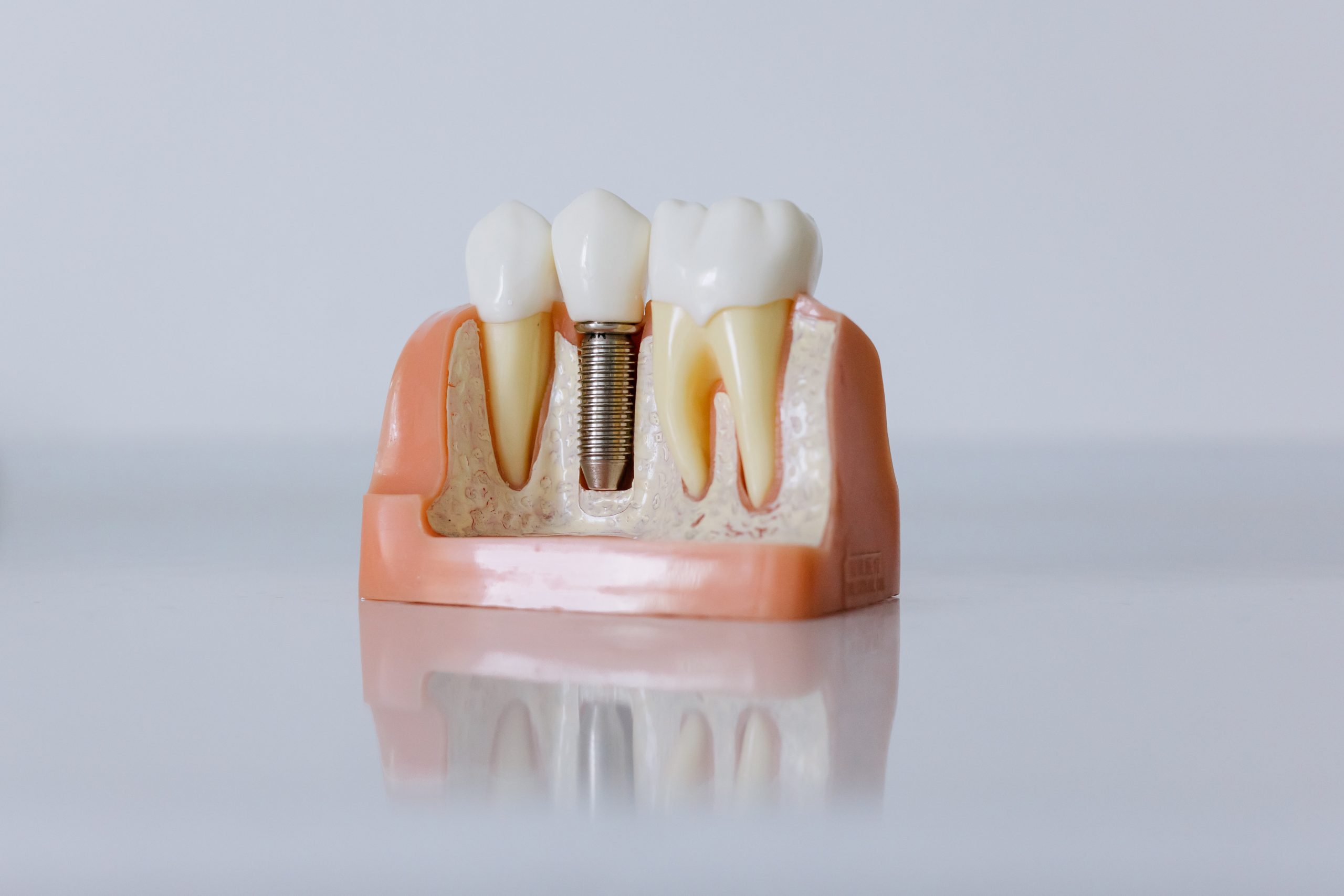 Qualité des implants dentaires en Hongrie