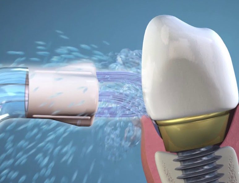 Le jet dentaire pour nettoyer un implant dentaire