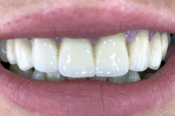 6-facettes-dentaires-E-MAX-cas-clinique-antalya-turquie-apres.jpg