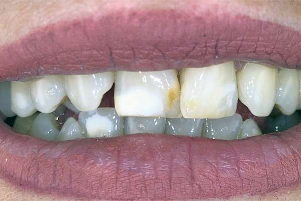 6-facettes-dentaires-E-MAX-cas-clinique-antalya-turquie-avant.jpg