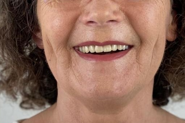 Implant-dentaire-Hongrie-apres.png