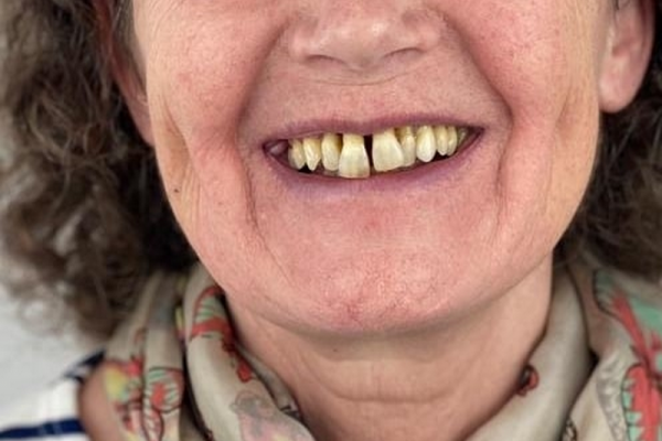 Implant-dentaire-Hongrie-avant.png