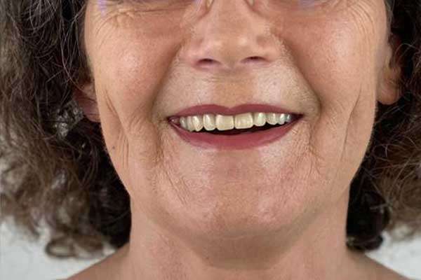 implants-dentaires-lisbonne-portugal-cas-cliniques-apres.jpg