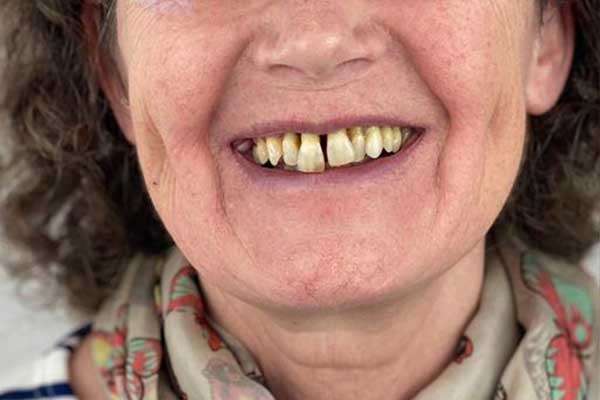 implants-dentaires-lisbonne-portugal-cas-cliniques-avant.jpg